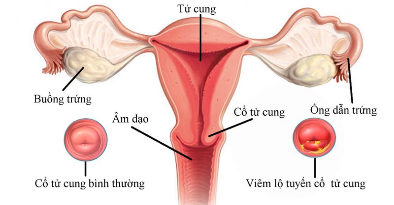 Viêm lộ tuyến cổ tử cung là chứng bệnh hay gặp nhất của phụ nữ thời kì hậu sản 