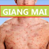 mot-so-hinh-anh-benh-giang-mai-o-nam-va-nu-gioi