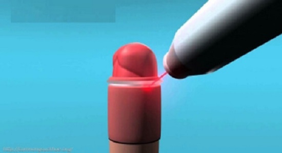 Công nghệ cắt bao quy đầu bằng laser