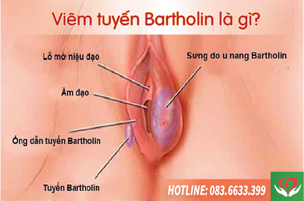 viêm tuyến bartholin là bệnh gì