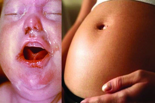 Phụ nữ mang thai mắc bệnh giang mai