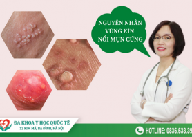 nguyen-nhan-noi-mun-cung-o-vung-kin-va-cach-chua-tri