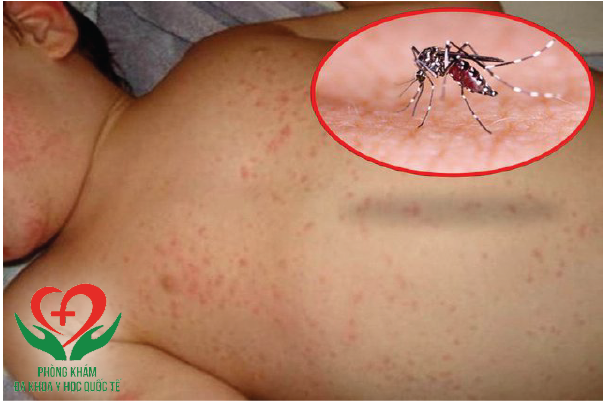 thông tin về bệnh sốt xuất huyết