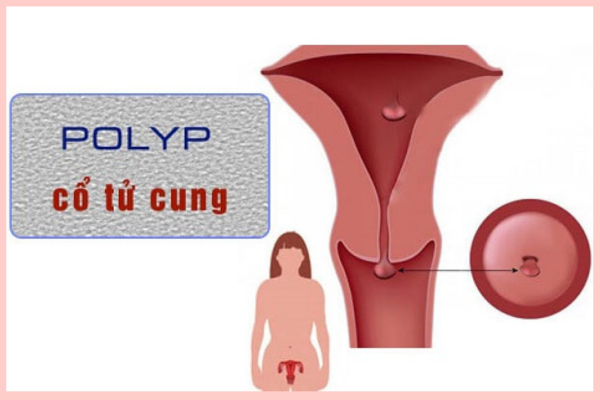 bệnh polyp cổ tử cung gây chậm kinh
